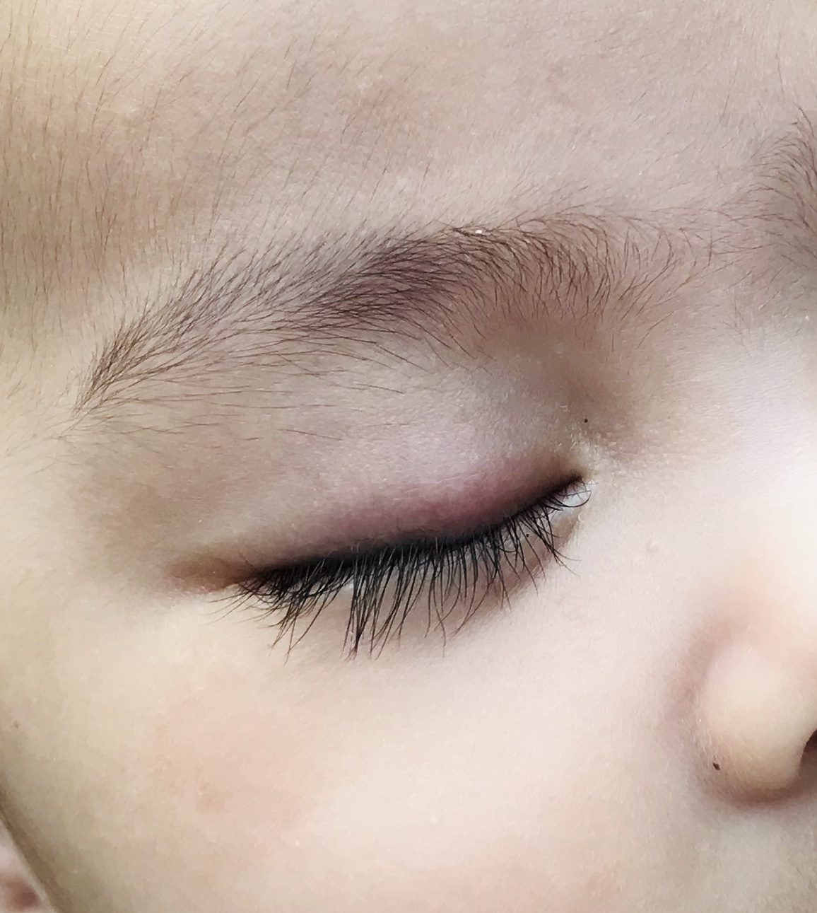 [新しいコレクション] 赤ちゃん まぶた 腫れ 257418赤ちゃん 瞼 腫れぼったい